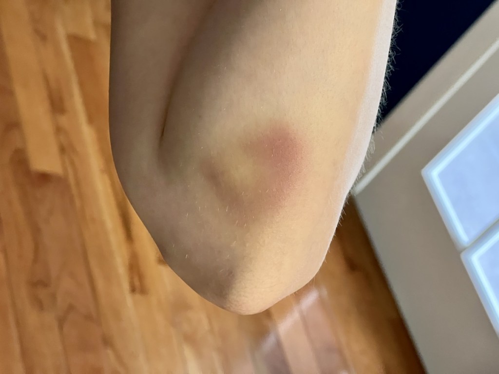 Lisa's elbow with a big bruise on it.
